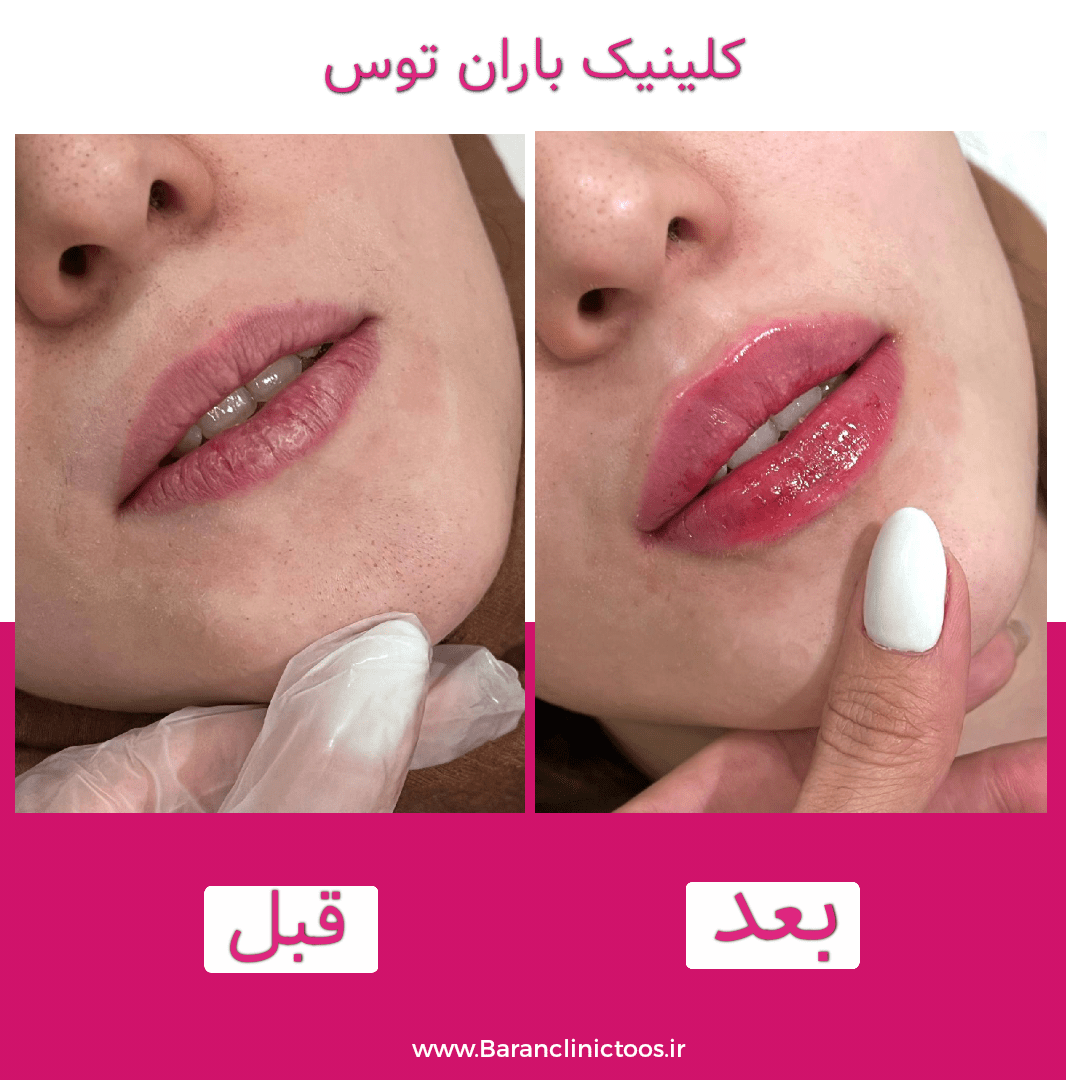 قبل و بعد فیلر لب